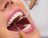 Coroa estética